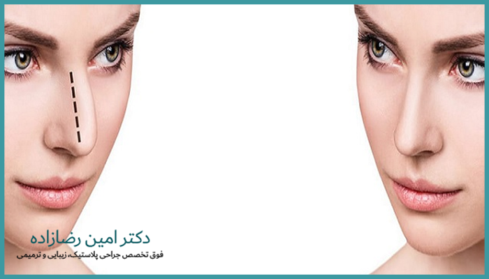 جراحی بینی غضروفی برای چه افرادی مناسب است؟