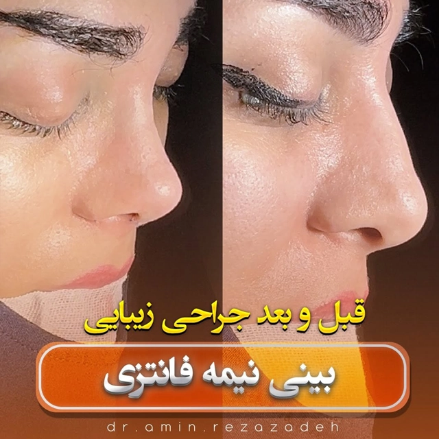 قبل و بعد از عمل بینی نیمه فانتزی دکتر امین رضا زاده